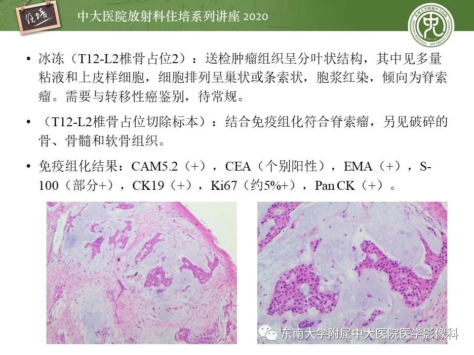 【PPT】脊柱骨源性病变影像分析思路及应用