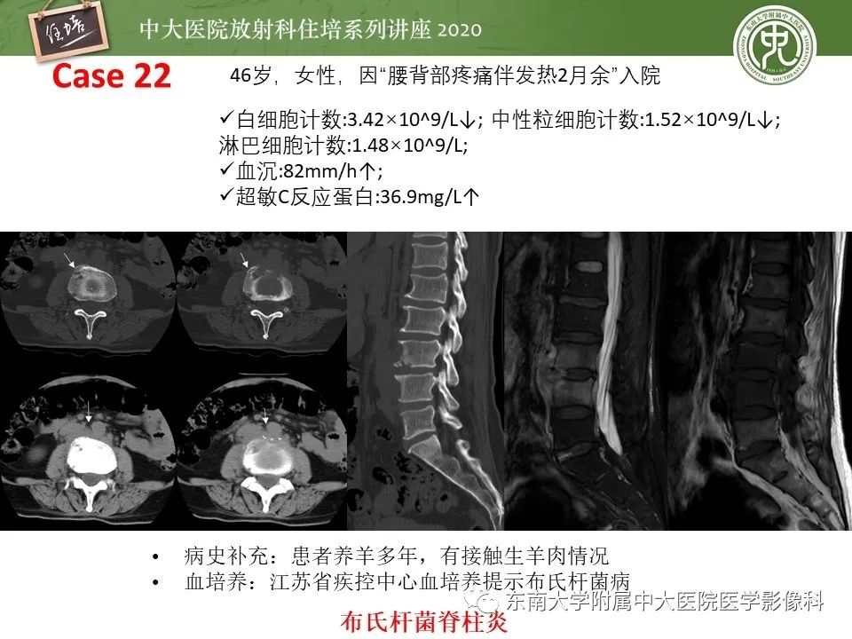 【PPT】脊柱骨源性病变影像分析思路及应用