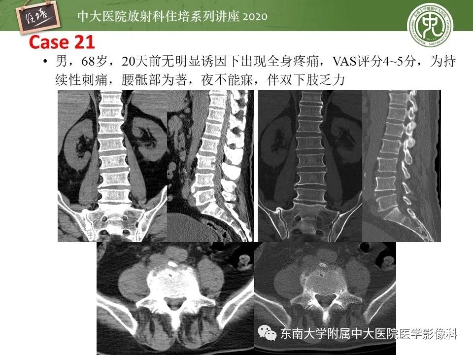 【PPT】脊柱骨源性病变影像分析思路及应用