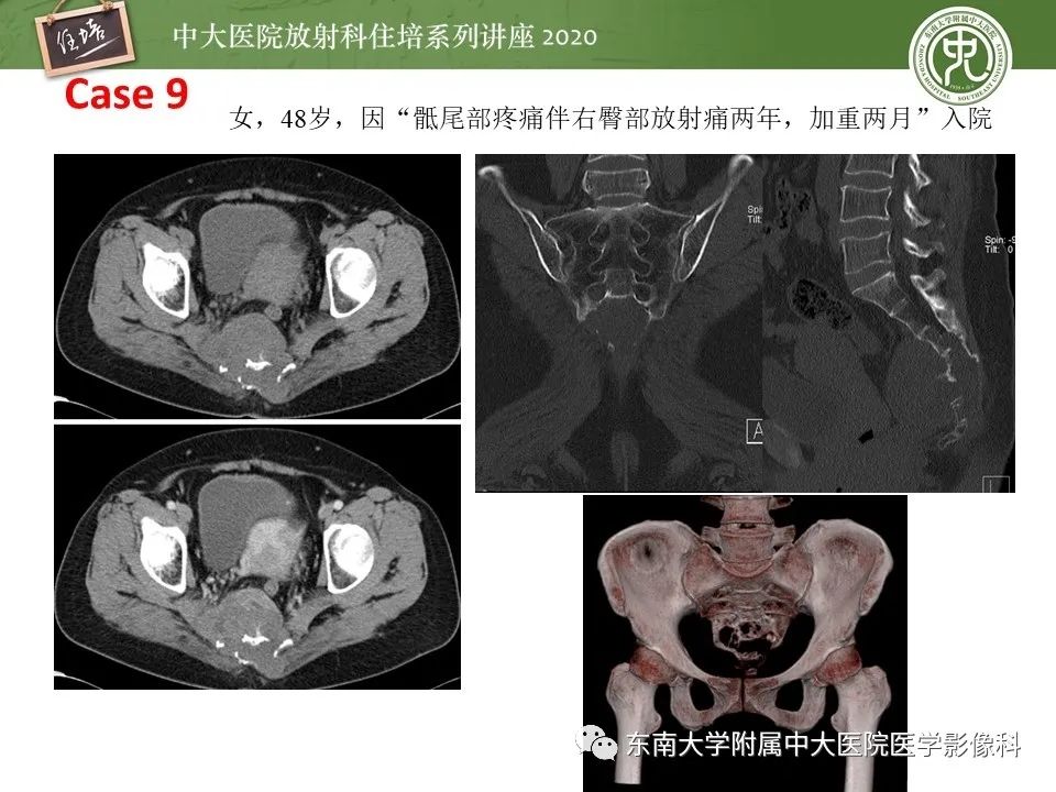 【PPT】脊柱骨源性病变影像分析思路及应用