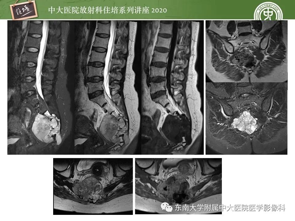 【PPT】脊柱骨源性病变影像分析思路及应用