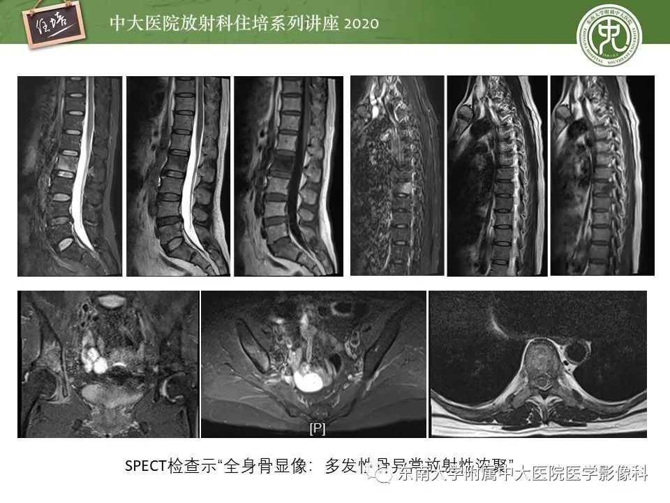 【PPT】脊柱骨源性病变影像分析思路及应用