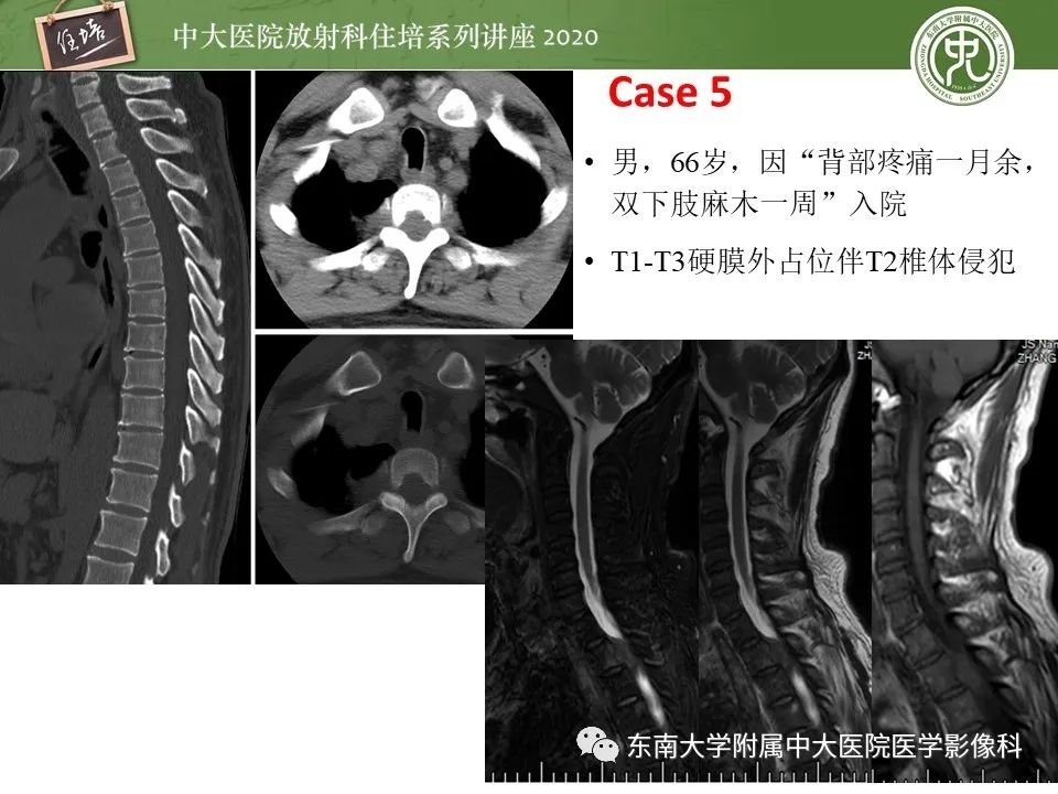 【PPT】脊柱骨源性病变影像分析思路及应用
