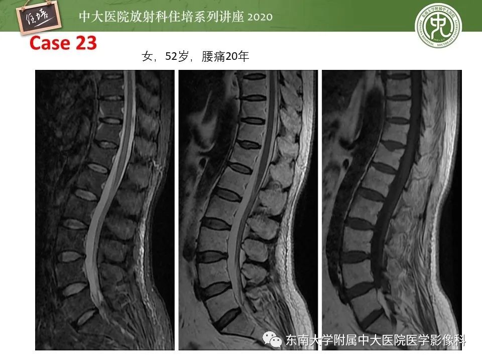【PPT】脊柱骨源性病变影像分析思路及应用