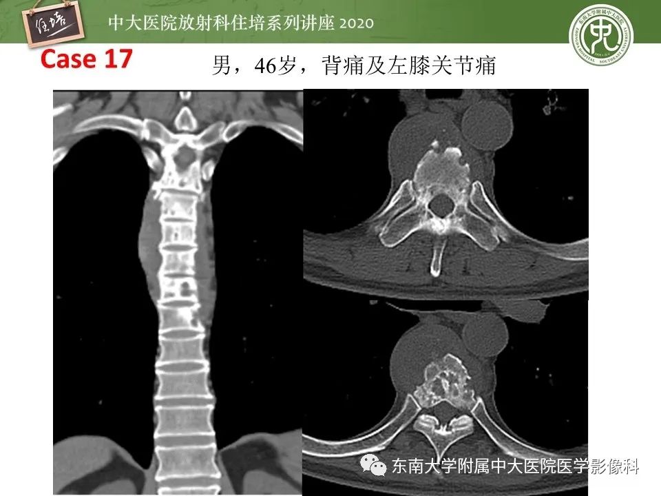 【PPT】脊柱骨源性病变影像分析思路及应用