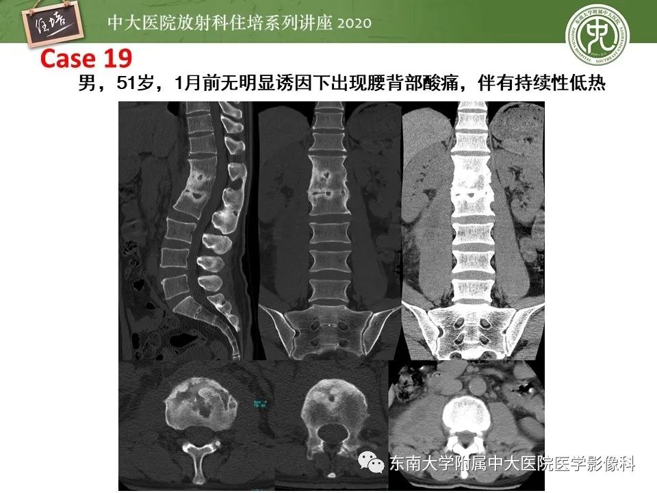【PPT】脊柱骨源性病变影像分析思路及应用