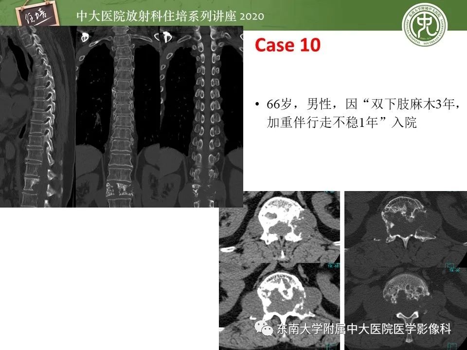 【PPT】脊柱骨源性病变影像分析思路及应用