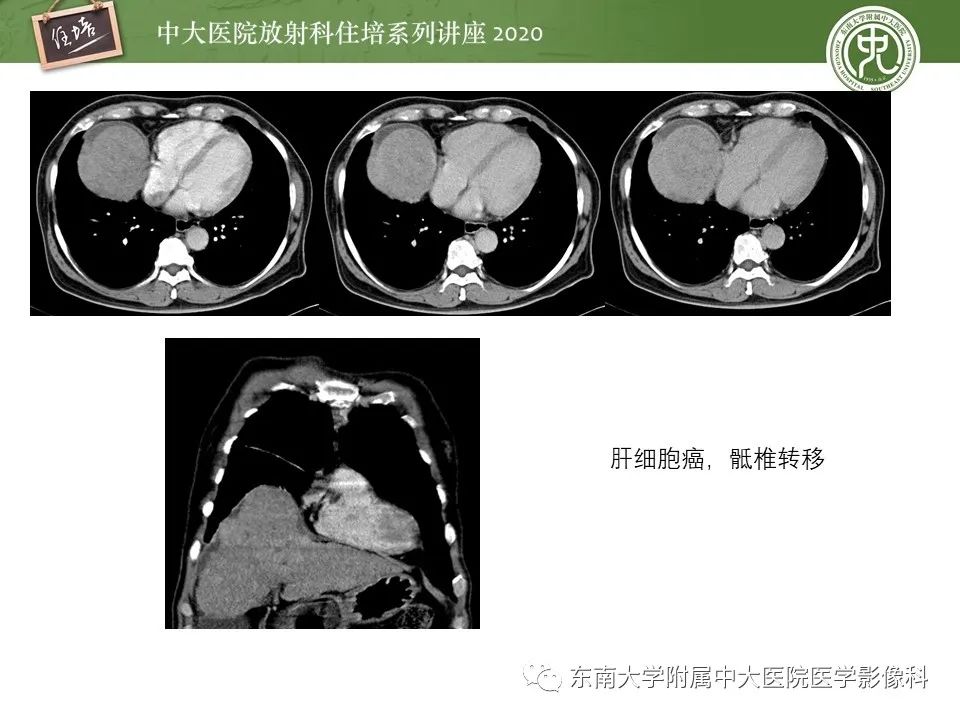 【PPT】脊柱骨源性病变影像分析思路及应用