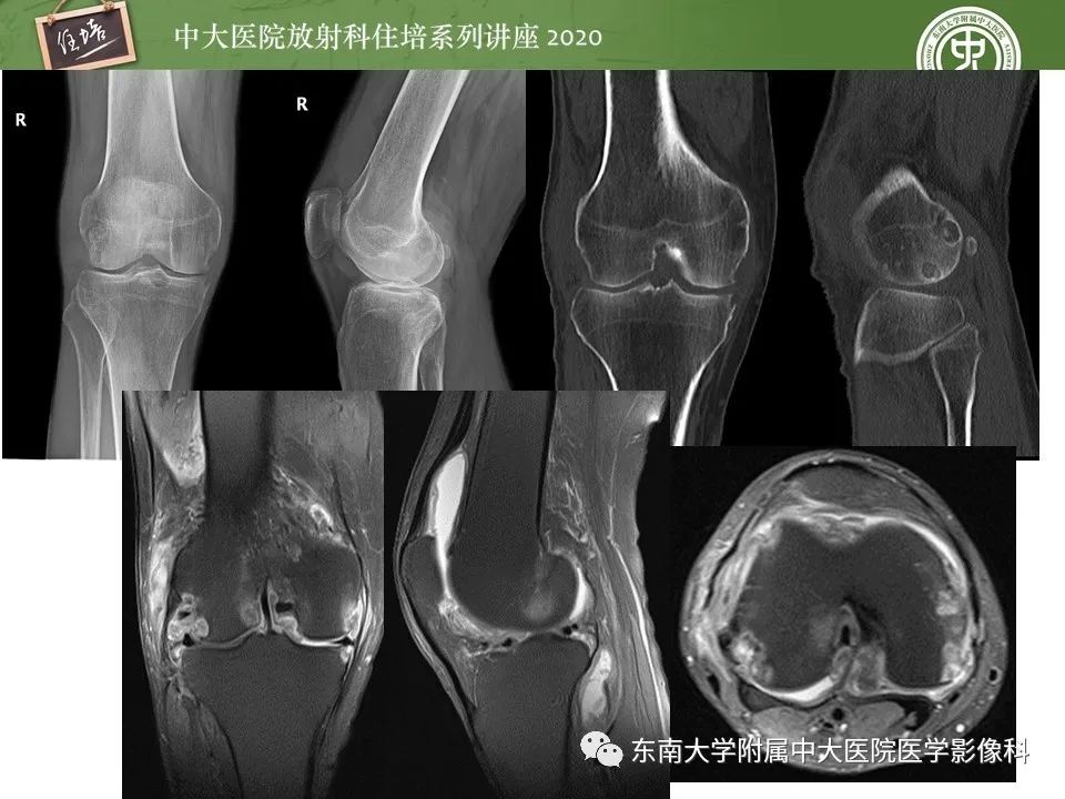 【PPT】脊柱骨源性病变影像分析思路及应用