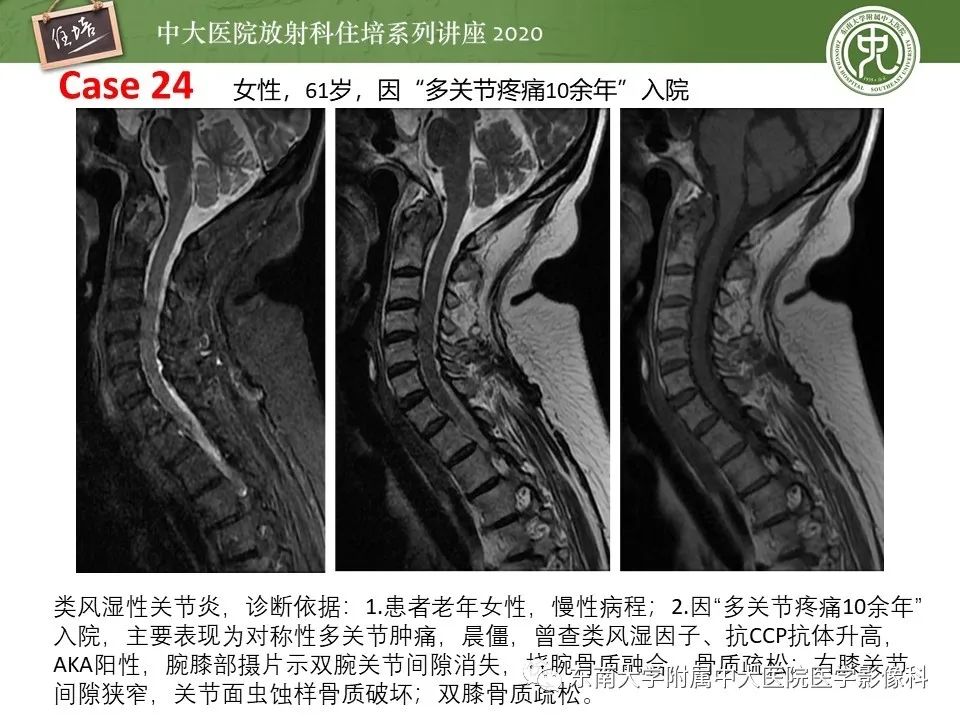 【PPT】脊柱骨源性病变影像分析思路及应用