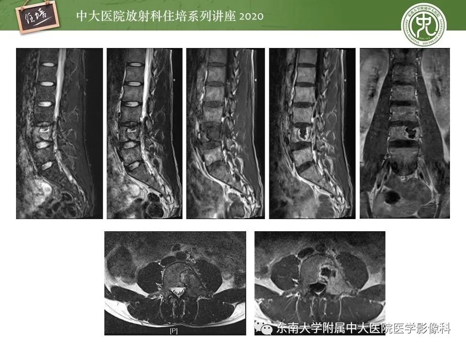 【PPT】脊柱骨源性病变影像分析思路及应用