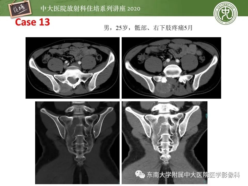 【PPT】脊柱骨源性病变影像分析思路及应用