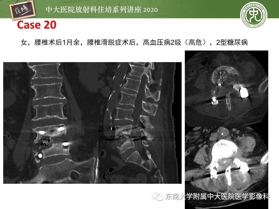 【PPT】脊柱骨源性病变影像分析思路及应用