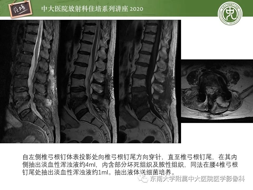 【PPT】脊柱骨源性病变影像分析思路及应用