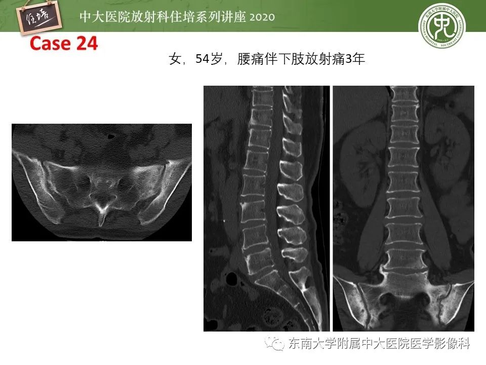 【PPT】脊柱骨源性病变影像分析思路及应用