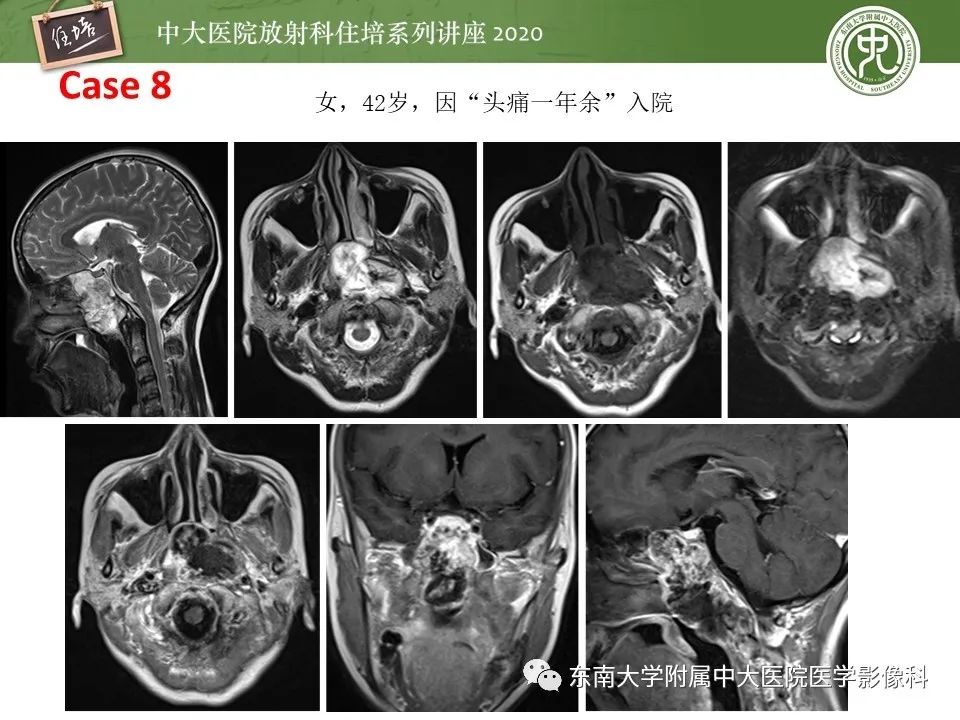 【PPT】脊柱骨源性病变影像分析思路及应用