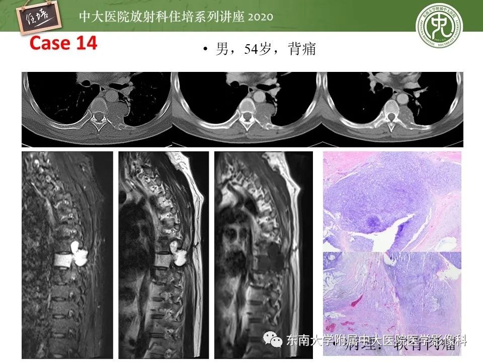 【PPT】脊柱骨源性病变影像分析思路及应用