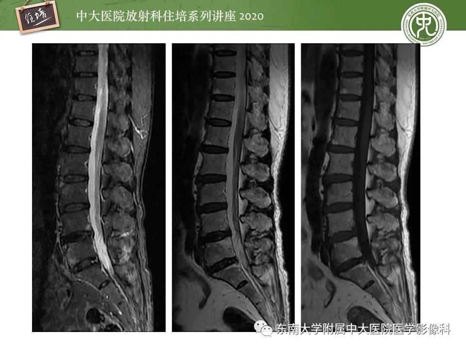 【PPT】脊柱骨源性病变影像分析思路及应用
