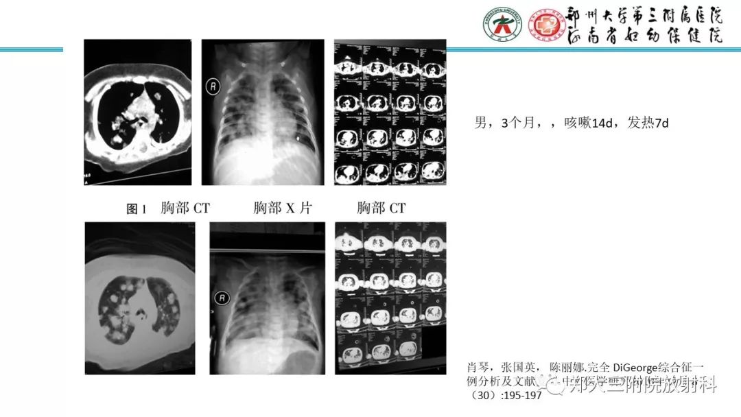 【PPT】DiGeorge迪格奥尔格综合征