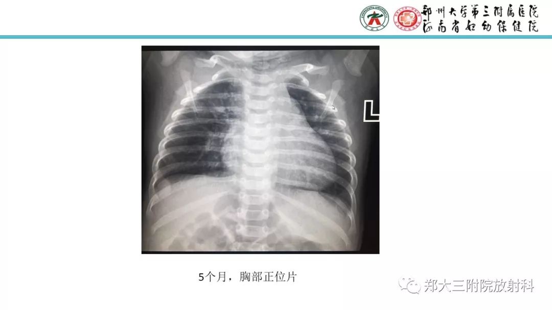 【PPT】DiGeorge迪格奥尔格综合征