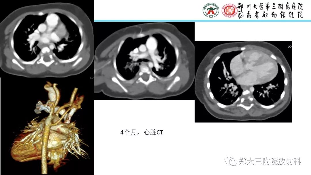 【PPT】DiGeorge迪格奥尔格综合征
