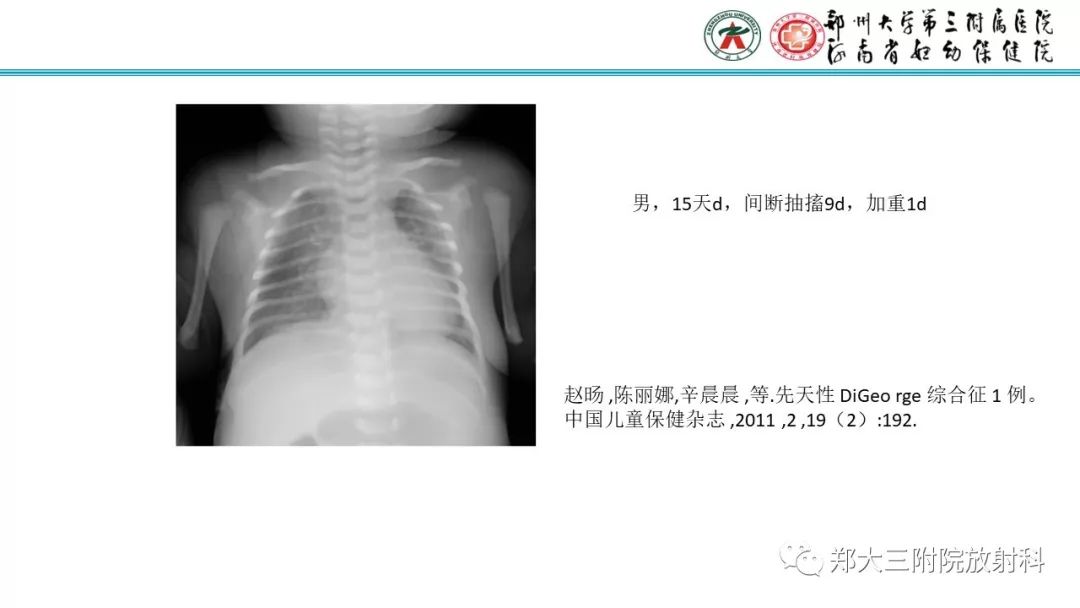 【PPT】DiGeorge迪格奥尔格综合征
