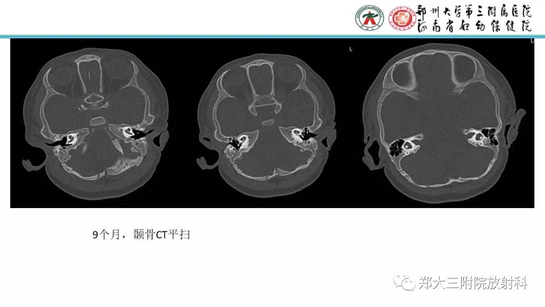 【PPT】DiGeorge迪格奥尔格综合征