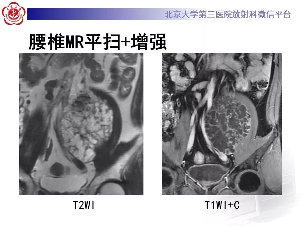 【PPT】原发性脊柱软骨肉瘤