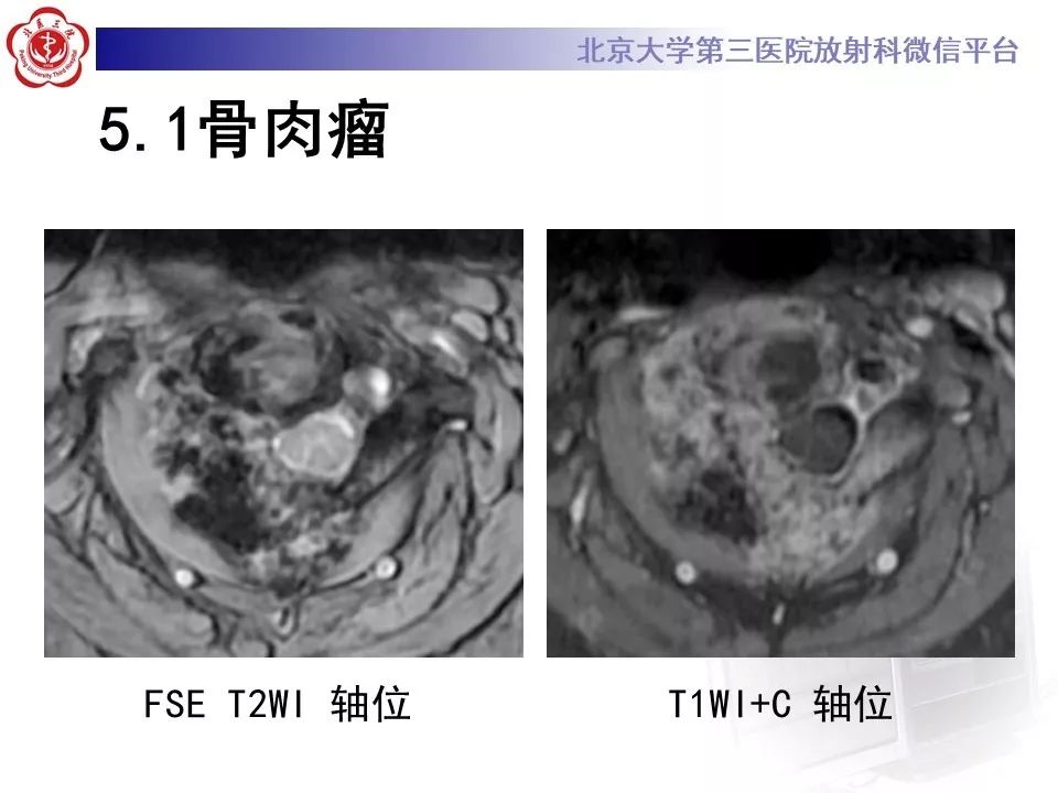 【PPT】原发性脊柱软骨肉瘤