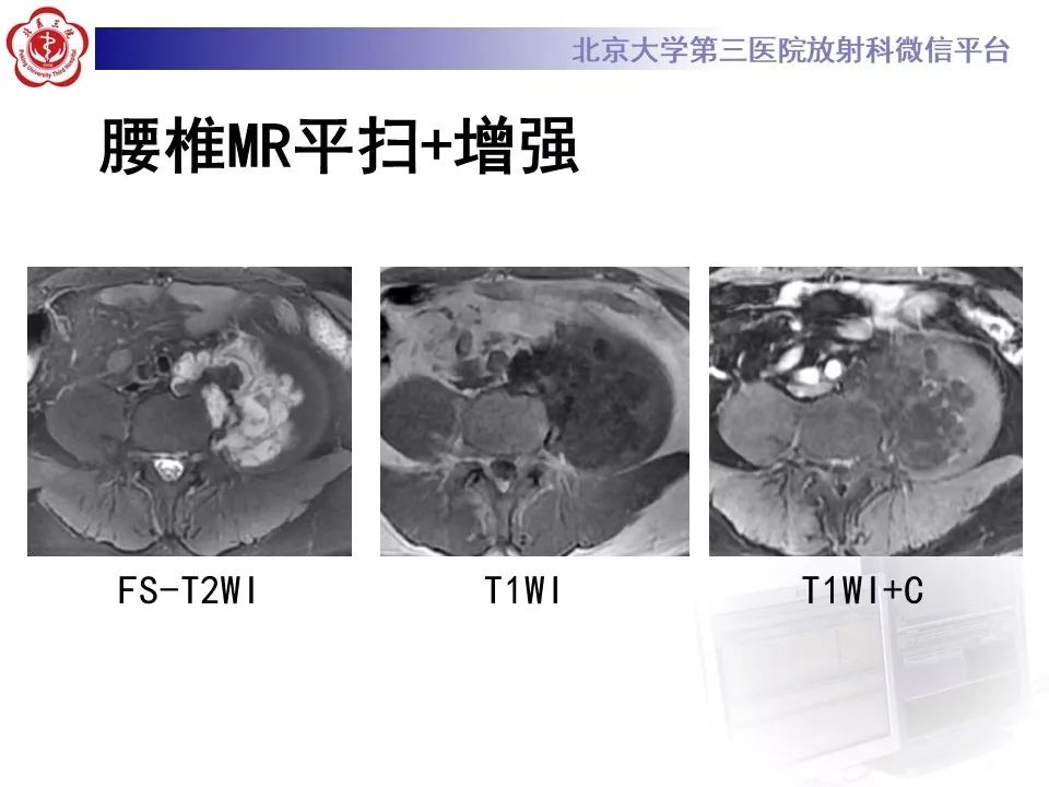【PPT】原发性脊柱软骨肉瘤