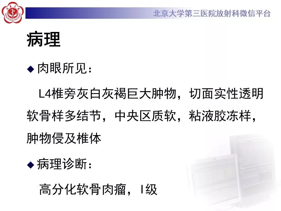 【PPT】原发性脊柱软骨肉瘤
