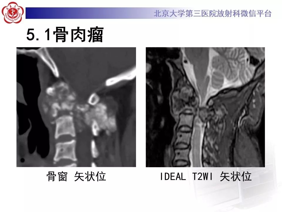【PPT】原发性脊柱软骨肉瘤
