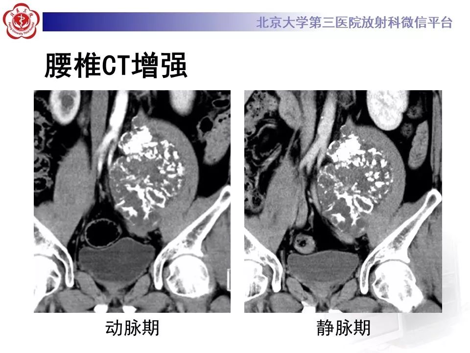 【PPT】原发性脊柱软骨肉瘤