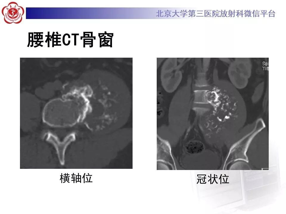 【PPT】原发性脊柱软骨肉瘤