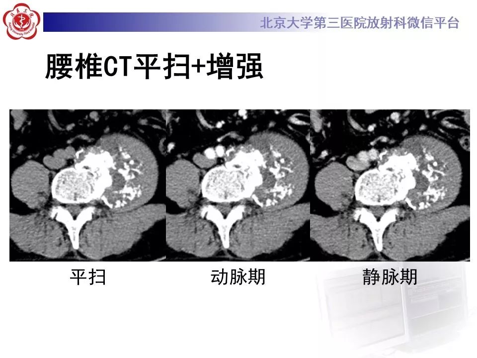 【PPT】原发性脊柱软骨肉瘤