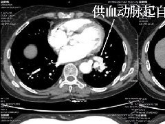 叶内型肺隔离症CT影像表现