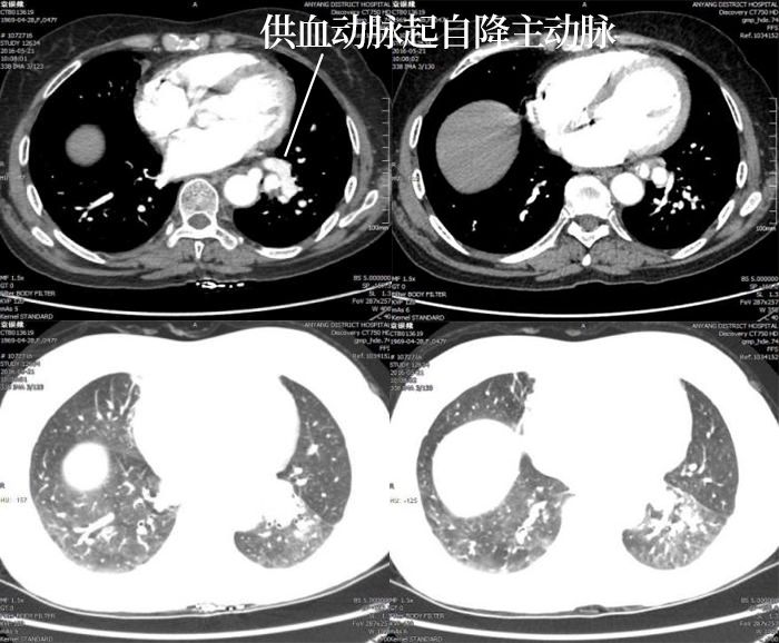 叶内型肺隔离症CT影像表现 叶内型肺隔离症CT影像表现
