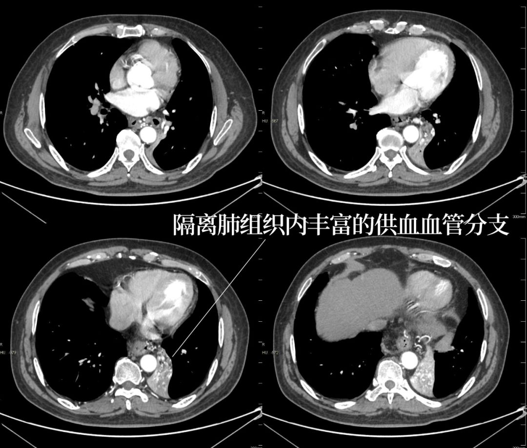 叶内型肺隔离症CT影像表现 叶内型肺隔离症CT影像表现