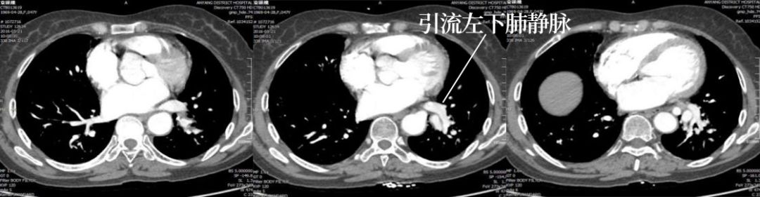 叶内型肺隔离症CT影像表现 叶内型肺隔离症CT影像表现