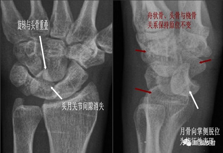 腕骨脱位的分类及X线表现