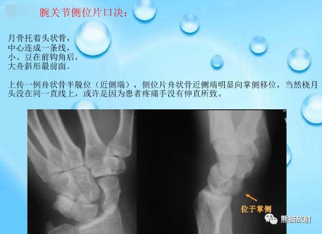 腕骨脱位的分类及X线表现