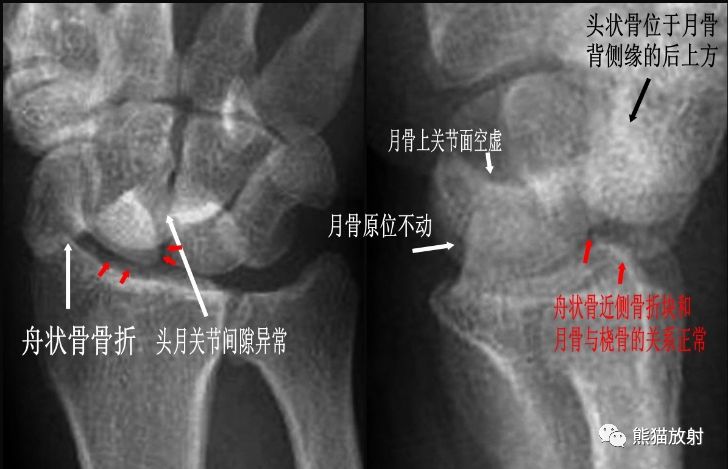 腕骨脱位的分类及X线表现