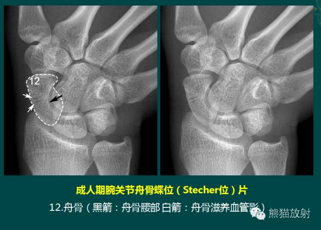 腕骨脱位的分类及X线表现