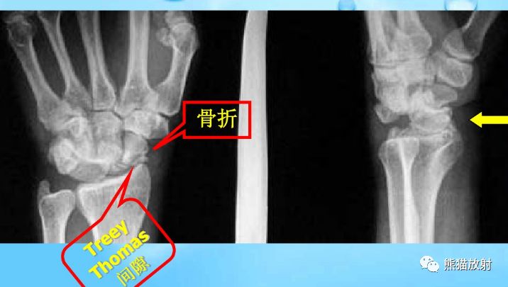 腕骨脱位的分类及X线表现