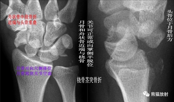 腕骨脱位的分类及X线表现