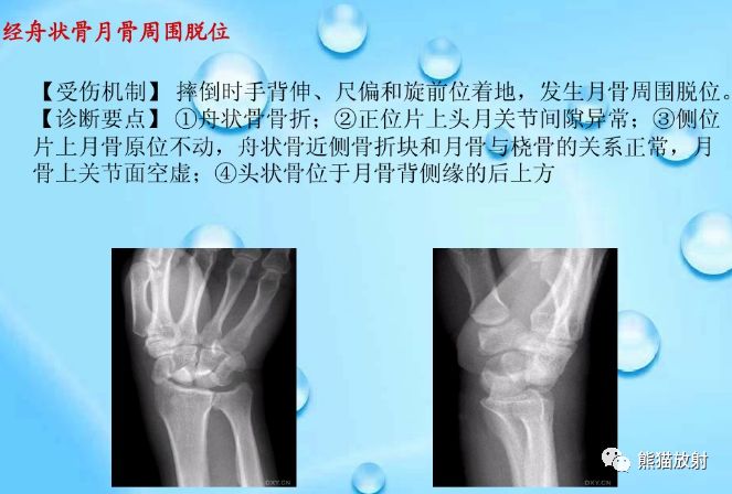 腕骨脱位的分类及X线表现