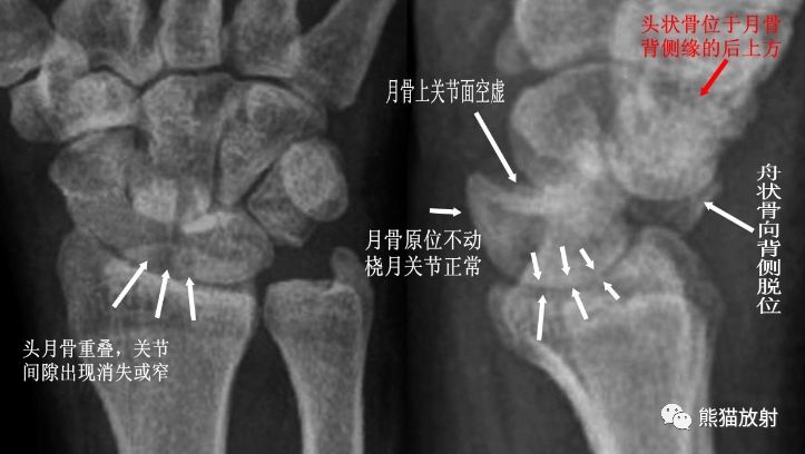 腕骨脱位的分类及X线表现