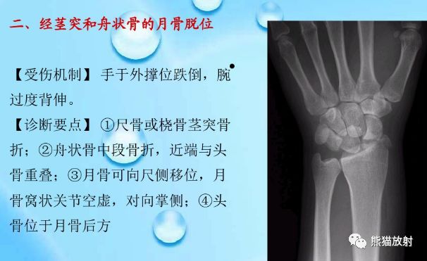腕骨脱位的分类及X线表现