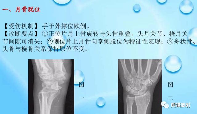 腕骨脱位的分类及X线表现