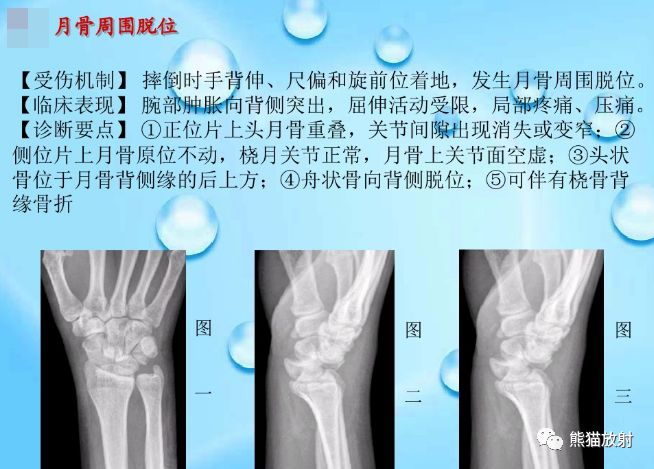 腕骨脱位的分类及X线表现